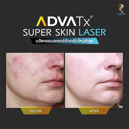 Super Skin Laser รักษาฝ้า กระ และจุดด่างดำ