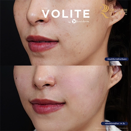 ฉีดฟิลเลอร์ (New Juvederm Volite)