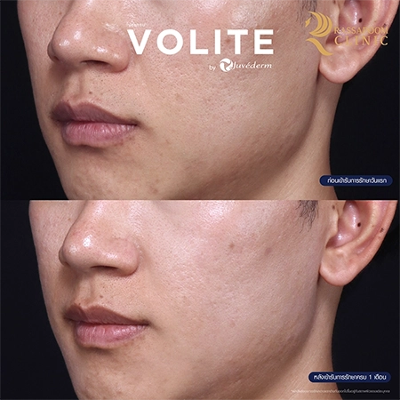 ฉีดฟิลเลอร์ (New Juvederm Volite)