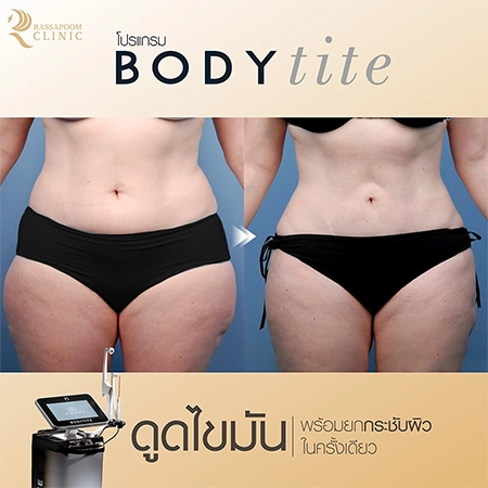 ดูดไขมัน BodyTite