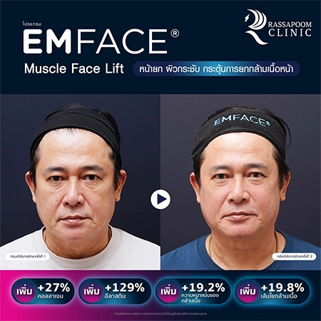 ยกกระชับกล้ามเนื้อ ยกกระชับ EMFACE