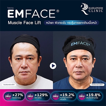 ยกกระชับกล้ามเนื้อ ยกกระชับ EMFACE