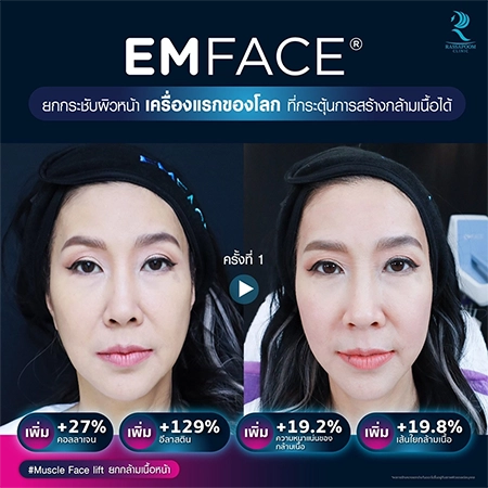 ยกกระชับกล้ามเนื้อ ยกกระชับ EMFACE