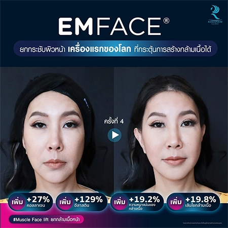 ยกกระชับกล้ามเนื้อ ยกกระชับ EMFACE