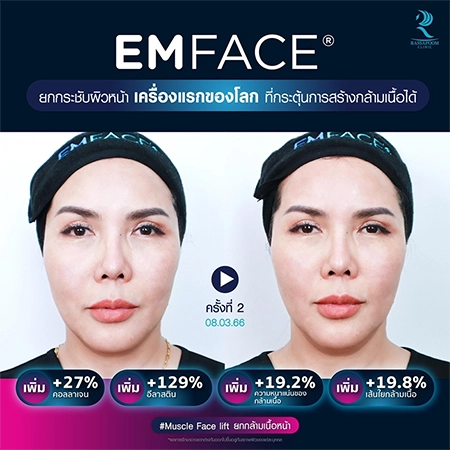 ยกกระชับกล้ามเนื้อ ยกกระชับ EMFACE