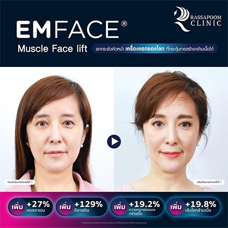 ยกกระชับกล้ามเนื้อ ยกกระชับ EMFACE