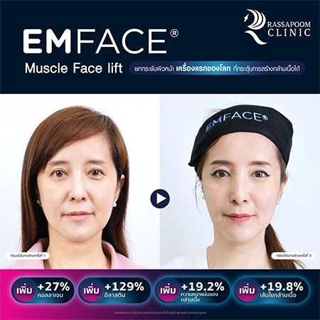 ยกกระชับกล้ามเนื้อ ยกกระชับ EMFACE