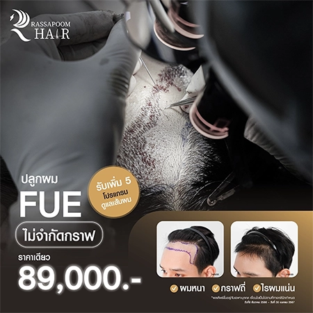 โปรแกรมปลูกผม FUE กราฟละ 69 เหมา 89,000 ไม่จำกัดกราฟ