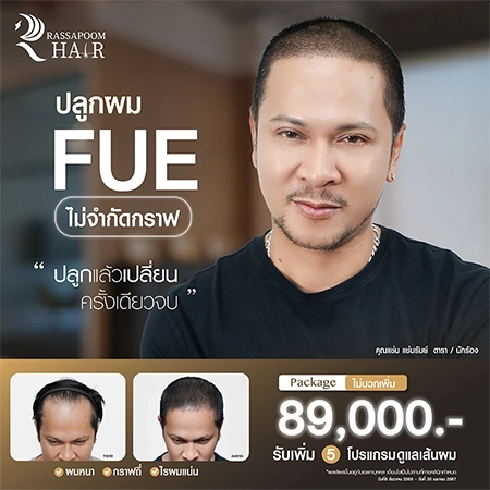 โปรแกรมปลูกผม FUE กราฟละ 69 เหมา 89,000 ไม่จำกัดกราฟ