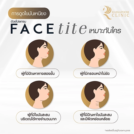 ดูดไขมันเหนียง แก้ปัญหาคางสองชั้น FaceTite AccuTite