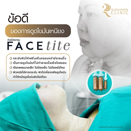 ดูดไขมันเหนียง แก้ปัญหาคางสองชั้น FaceTite AccuTite