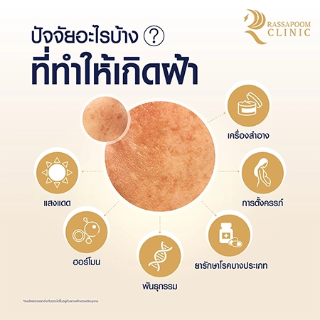 ฝ้า Melasma