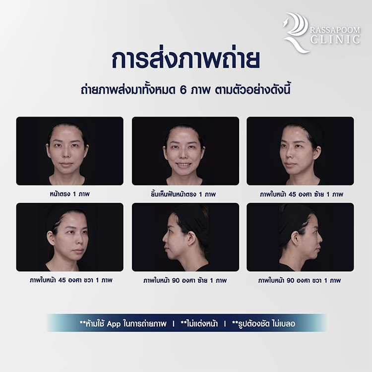 กิจกรรมแจกฟรีโปรแกรมฉีดฟิลเลอร์ 14 cc (MID FACE)