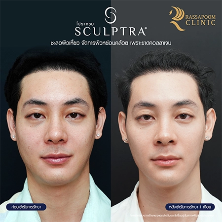 Sculptra คุณแพลน