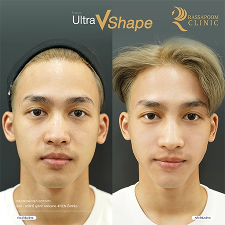 Ultra V Shape คุณนินจา