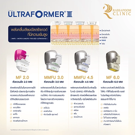 Ultraformer III ยกกระชับ ลดริ้วรอย สลายไขมันใต้ชั้นผิว