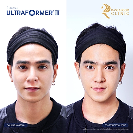 Ultraformer III ยกกระชับ ลดริ้วรอย สลายไขมันใต้ชั้นผิว