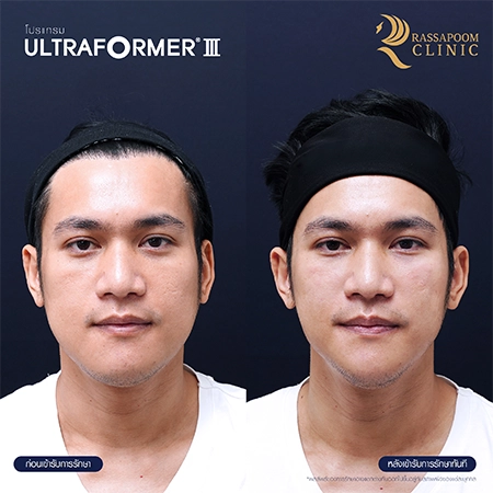 Ultraformer III ยกกระชับ ลดริ้วรอย สลายไขมันใต้ชั้นผิว