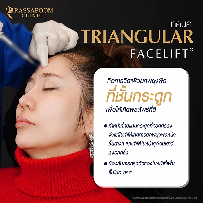 ฉีดฟิลเลอร์ (Triangular Face Lift)