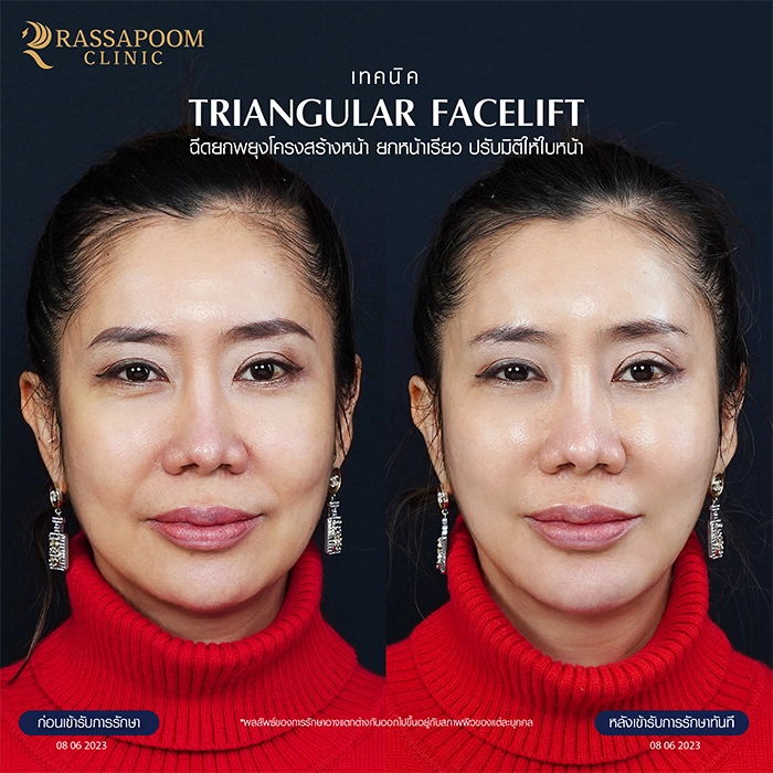 ฉีดฟิลเลอร์ (Triangular Face Lift)