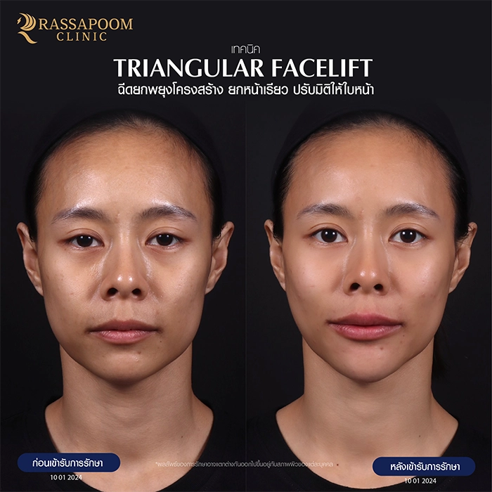 ฉีดฟิลเลอร์ (Triangular Face Lift)