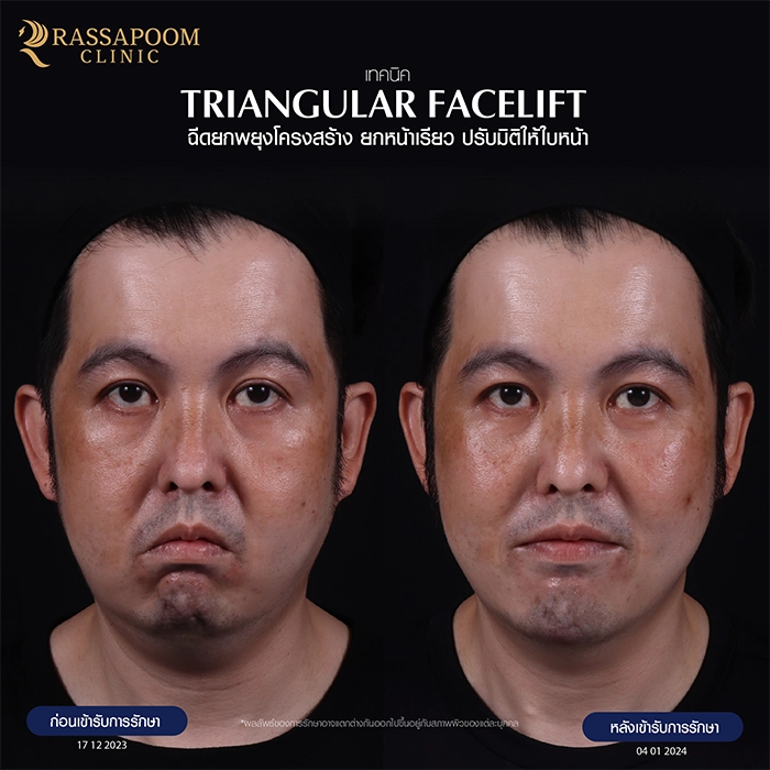 ฉีดฟิลเลอร์ (Triangular Face Lift)