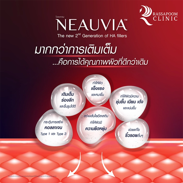 Neauvia ฟิลเลอร์