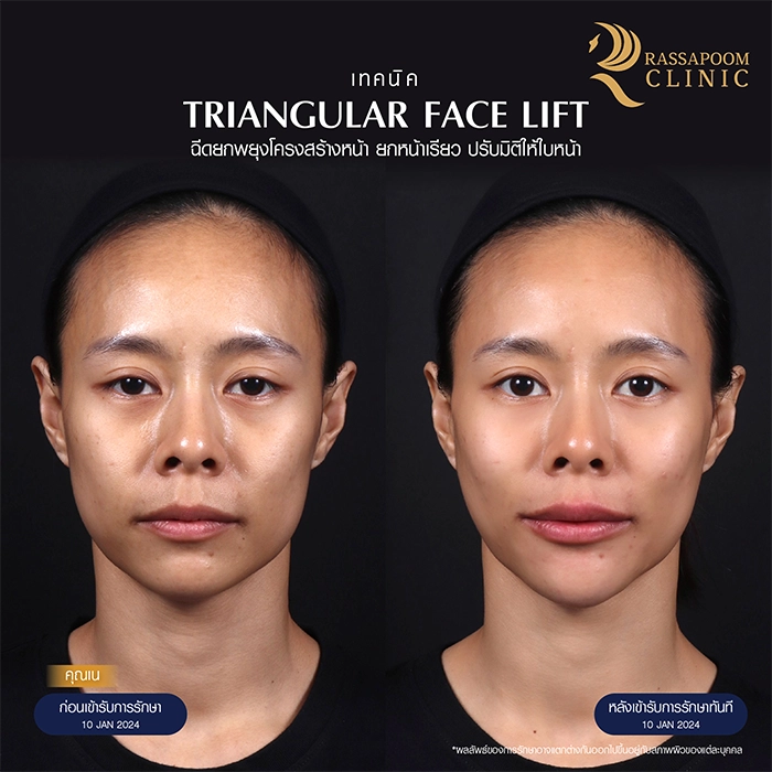 ฉีดยกพยุงโครงสร้างใบหน้า Triangular Face Lift คุณเนติกาญจน์ มหิทธิพงศ์กุล