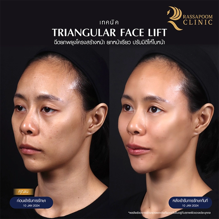 ฉีดยกพยุงโครงสร้างใบหน้า Triangular Face Lift คุณเนติกาญจน์ มหิทธิพงศ์กุล