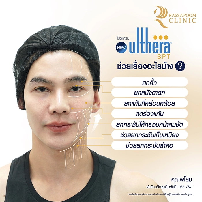 New Ulthera SPT (คุณพโยม)