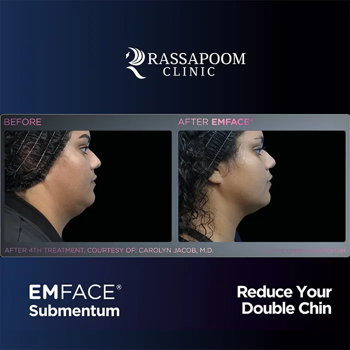 EMFACE Submentum ลดเหนียง