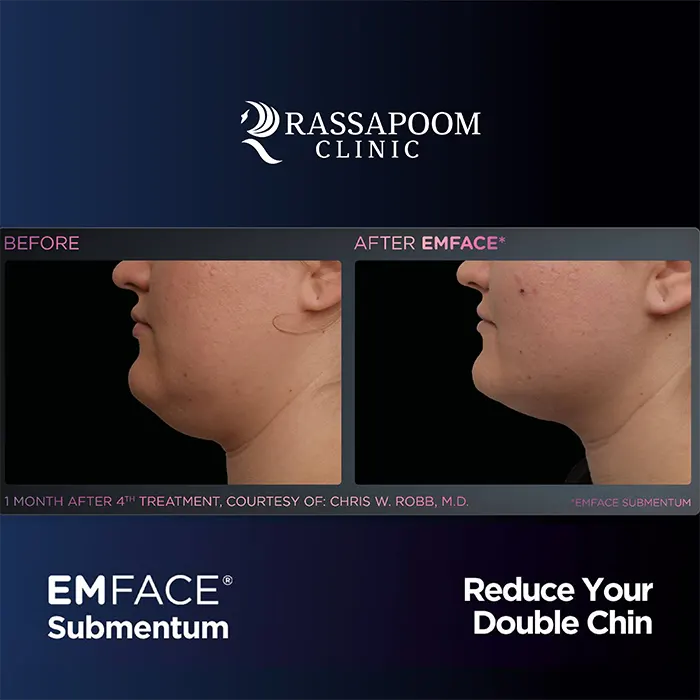 EMFACE Submentum ลดเหนียง