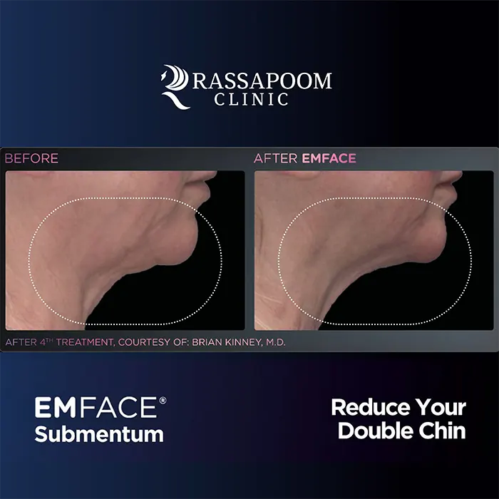 EMFACE Submentum ลดเหนียง