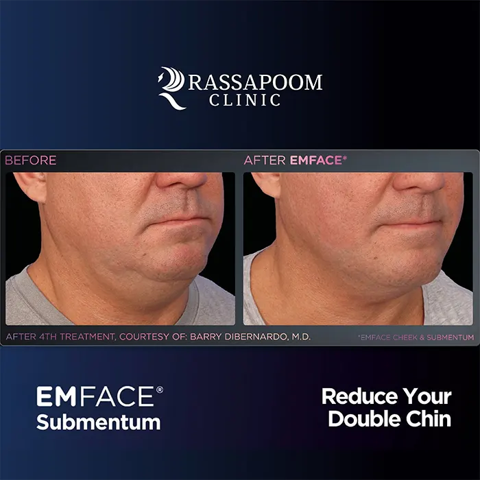 EMFACE Submentum ลดเหนียง