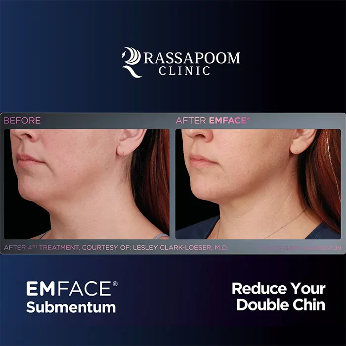 EMFACE Submentum ลดเหนียง