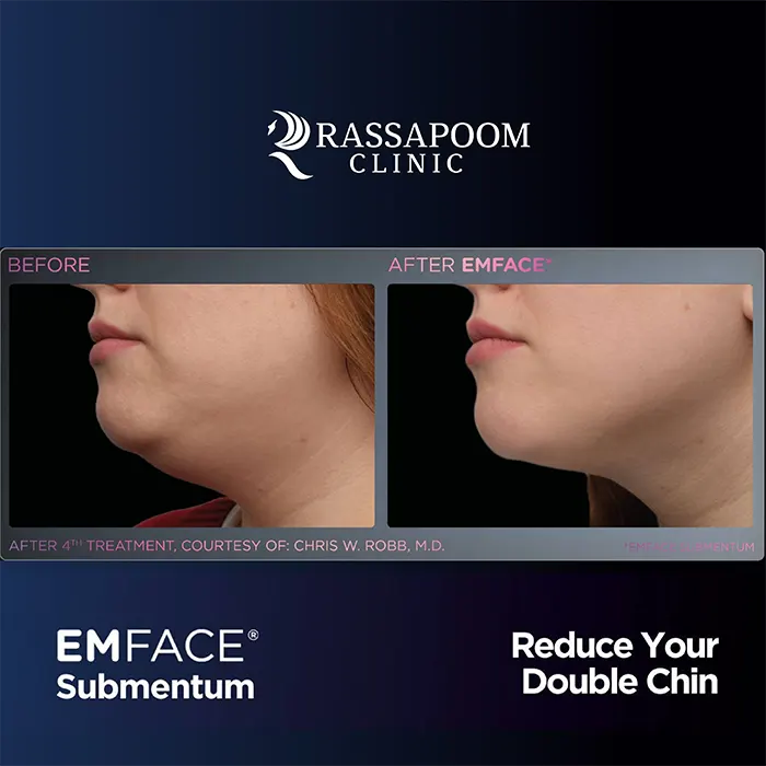 EMFACE Submentum ลดเหนียง