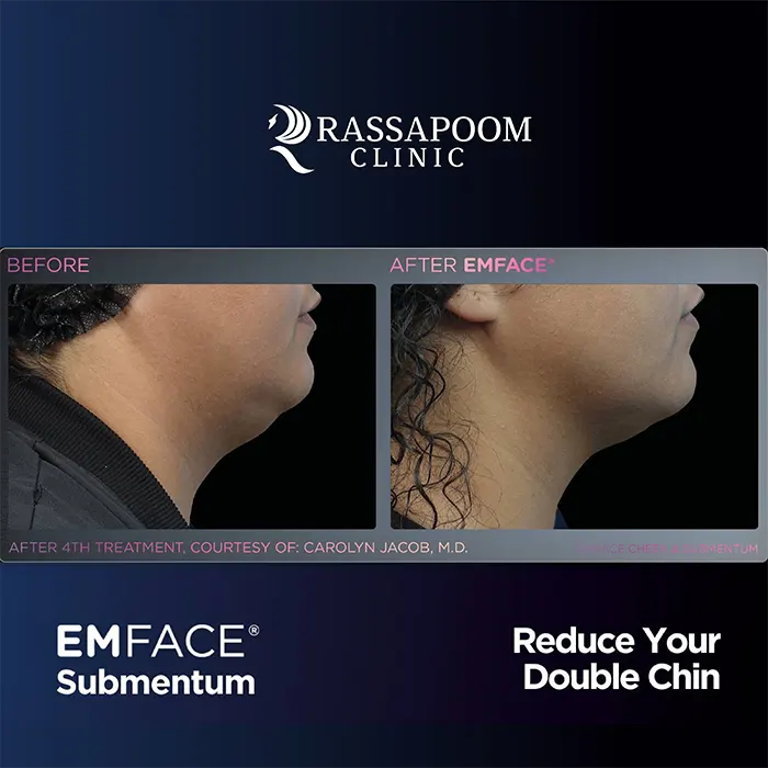 EMFACE Submentum ลดเหนียง